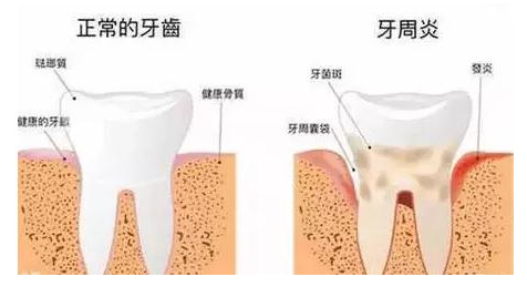 牙周炎