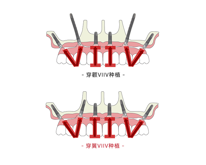 VIIV穿颧穿翼种植