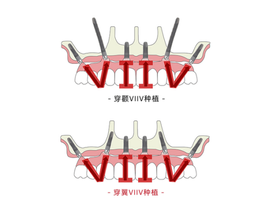 1780564657166971.png 鼎植穿颧穿翼种植